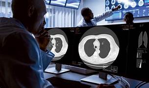 AI in detection of pneumonia